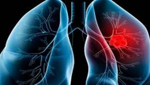 Akciğer kanseri kadınlarda da artıyor 
