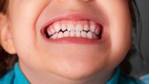 “Çocukların ne derdi var ki diş gıcırdatsın” demeyin!